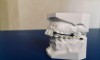 Avantajele Carriere Motion și a brackeților SLX, ca variantă modernă de tratament al afecțiunilor ortodontice