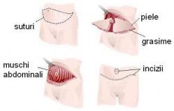 abdominoplastie