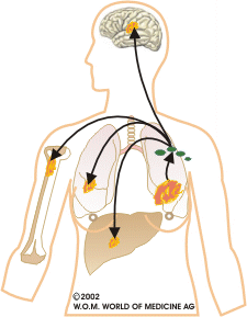 Metastazele si nodulii limfatici santinela