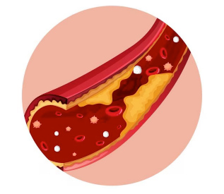 Legatura dintre bacteriile intestinale și ateroscleroză