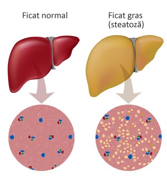 Noi descoperiri în domeniul patogenezei și terapiei bolilor hepatice cronice