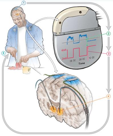 Stimularea cardiacă cu auto-ajustare poate ajuta la reducerea simptomelor bolii Parkinson