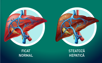 Două noi subtipuri de MASH (steatoză hepatică non-alcoolică) identificate: riscuri și rezultate distincte