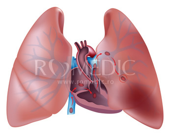 Cercetările dezvăluie cea mai bună strategie de tratament pentru embolia pulmonară cu risc ridicat